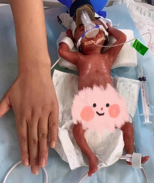 一位31岁的孕妇由于不明原因宫缩早产,怀孕近24周多,就生下了胎儿小