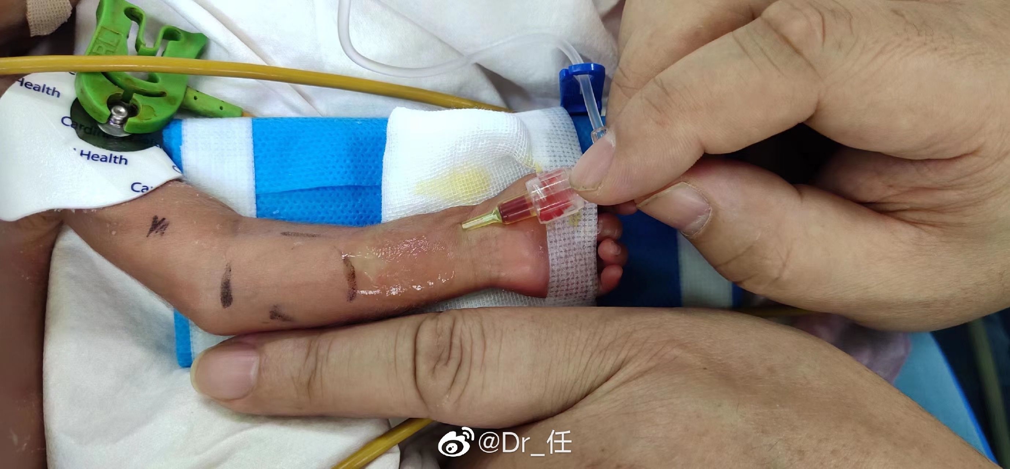 27周早产儿1公斤巴掌大粗大动脉导管未闭