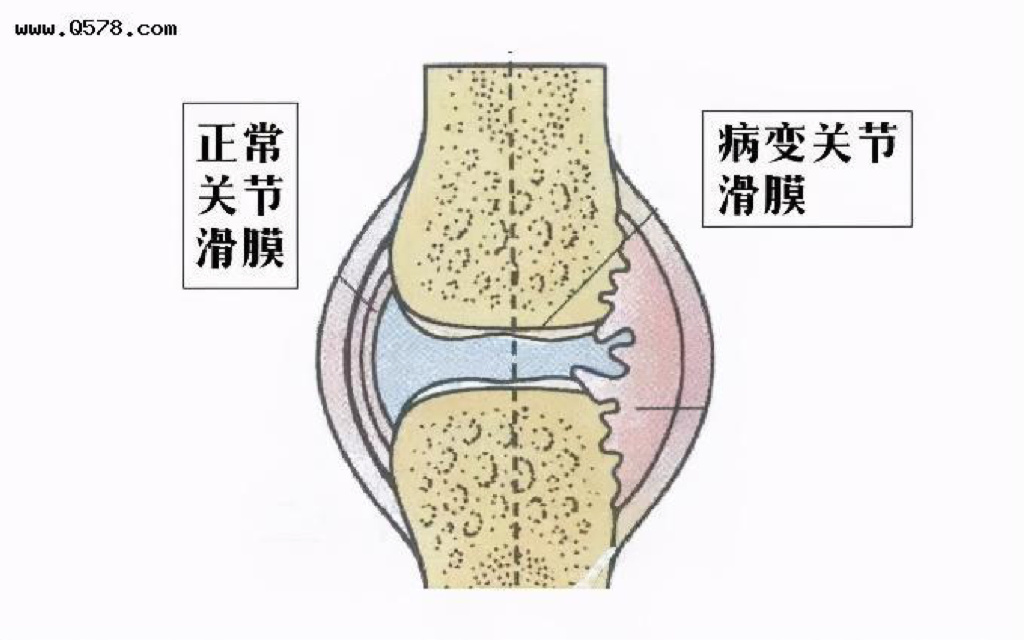久坐不动,当心坐骨结节滑膜炎的袭击!|滑囊炎|老年人|久坐_新浪新闻