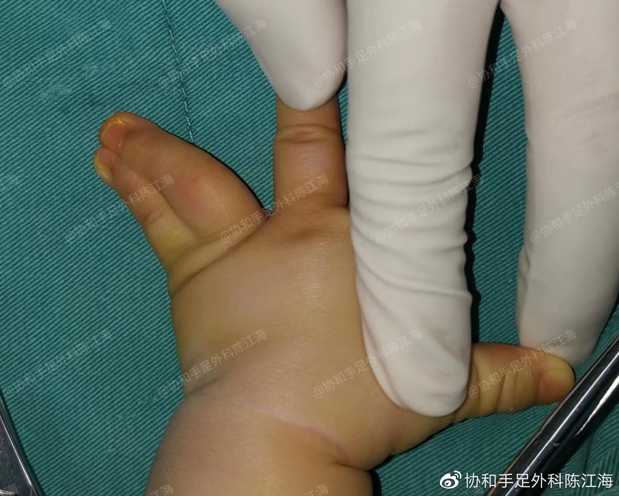 并指免植皮 | 案例10 《两根手指并成一根,术后恢复正常》|小宝宝