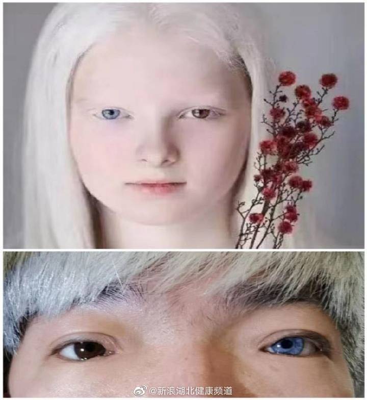 而其中有一种更为特殊的案例,他们天生患有虹膜异色症和先天性白化病