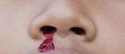 3岁男童仰头止鼻血致死！孩子常见意外应急处理的误区，你一定要知道休闲区蓝鸢梦想 - Www.slyday.coM