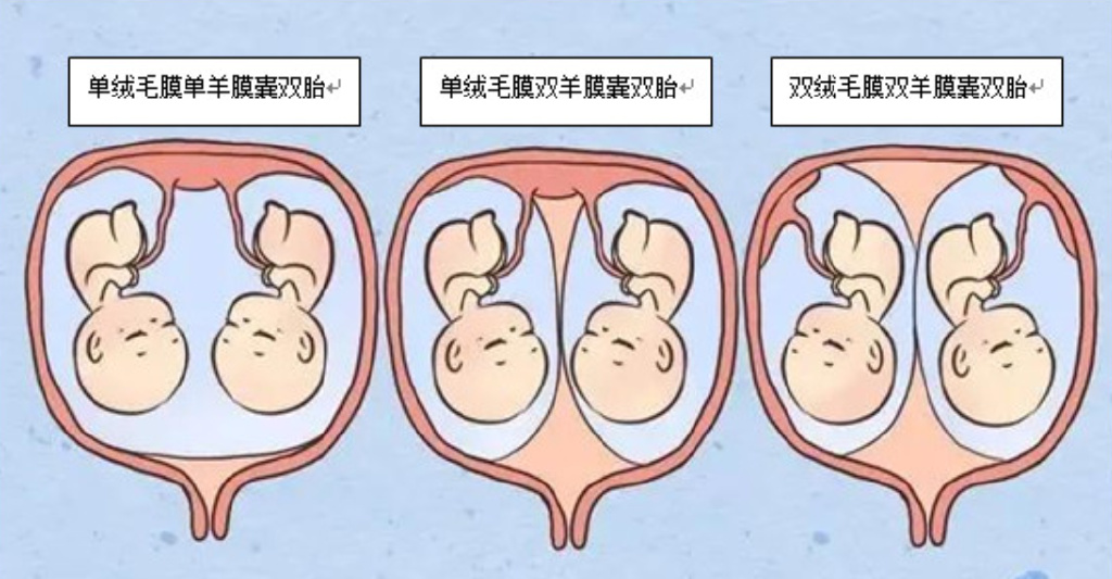 双胞胎分为双卵双胎和单卵双胎.