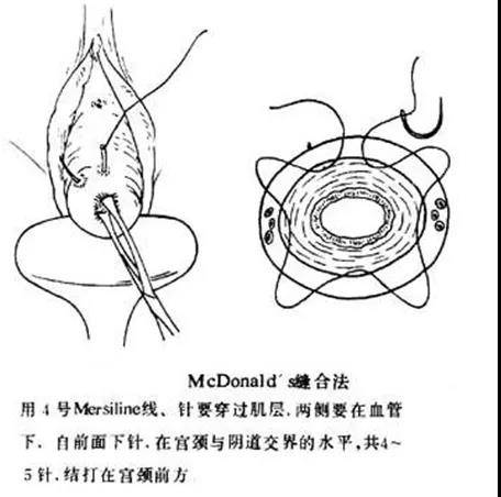 粤黔协作织金县人民医院成功实施首例宫颈环扎术