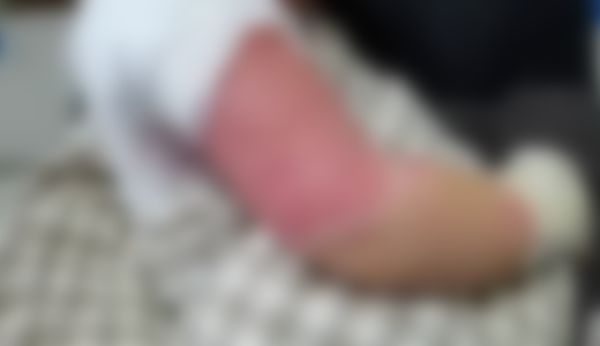 奶奶接电话时，1岁半宝宝打翻热水壶，医生：烫伤后别这么做休闲区蓝鸢梦想 - Www.slyday.coM