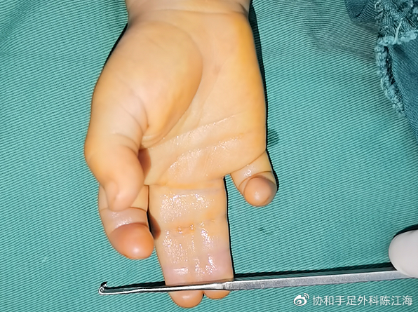 并指分离过程中在指蹼相对缘通常会出现皮肤软组织缺损,如果从孩子的