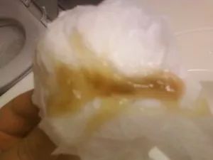 这是恶心的棕色鼻涕6黑色鼻涕宝宝黑色鼻涕有可能是吸入的粉尘太多