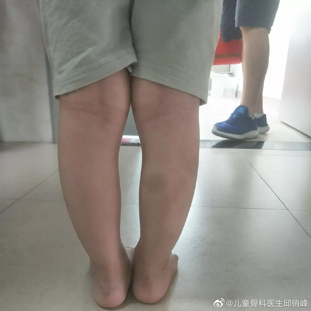 又一双完美恢复的足外翻,4岁