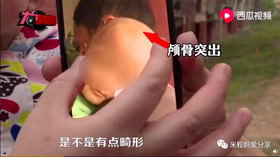多名婴儿变成"大头娃娃"