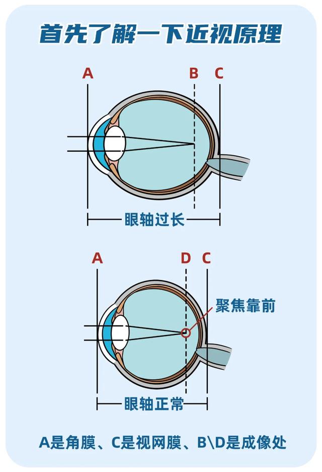 近视手术能不能做？想做又怕后遗症？你需要这篇科普休闲区蓝鸢梦想 - Www.slyday.coM