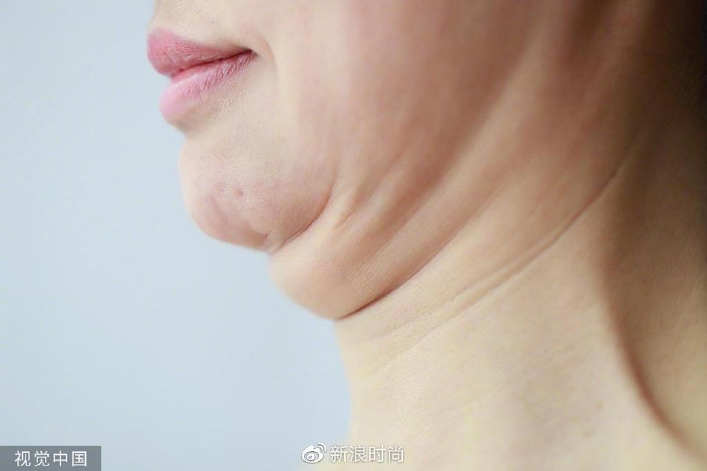出游拍照季 双下巴发腮脸如何找回“少女线”