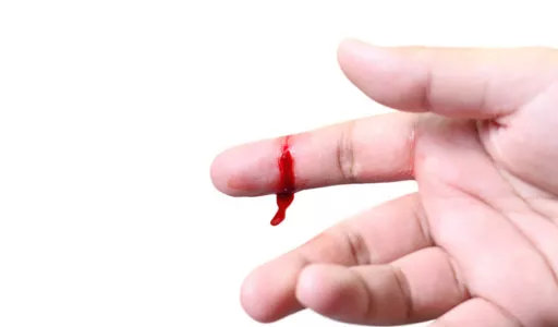 血友病患者,因凝血功能障碍在轻微外伤后容易出血不止或自发性出血