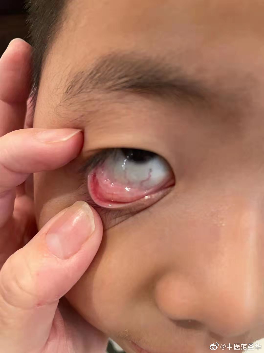 很早之前,治疗这位小朋友的眼睑结膜炎,眼睑发红,眼睛酸涩