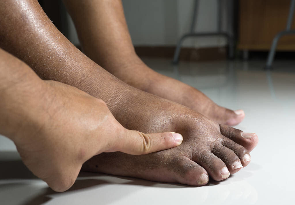 肺癌病人下肢浮肿会是什么原因?大部分不是肺癌直接造成的