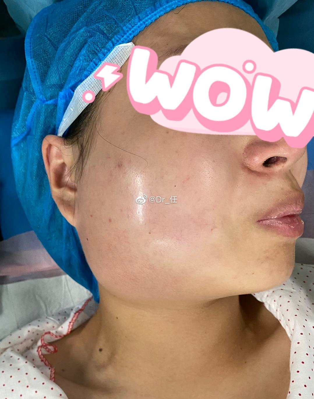 这是一位孕妇,智齿发炎导致颌面间隙感染,张口度不到一指_高清图集