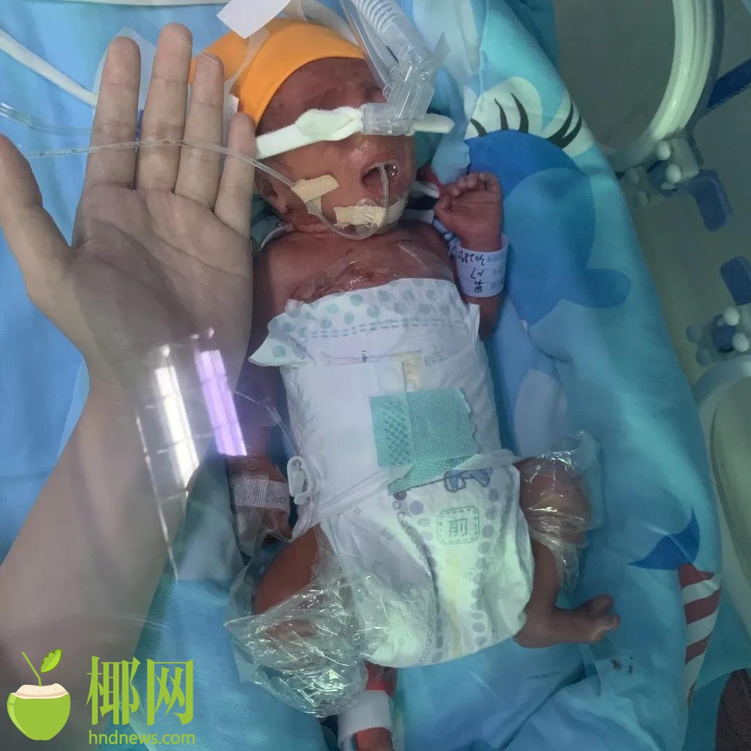 儋州市人民医院成功救治一名早产儿,小宝贝出生时仅有850g休闲区蓝鸢梦想 - Www.slyday.coM 儋州市人民医院成功救治一名早产儿,小宝贝出生时仅有850g休闲区蓝鸢梦想 - Www.slyday.coM