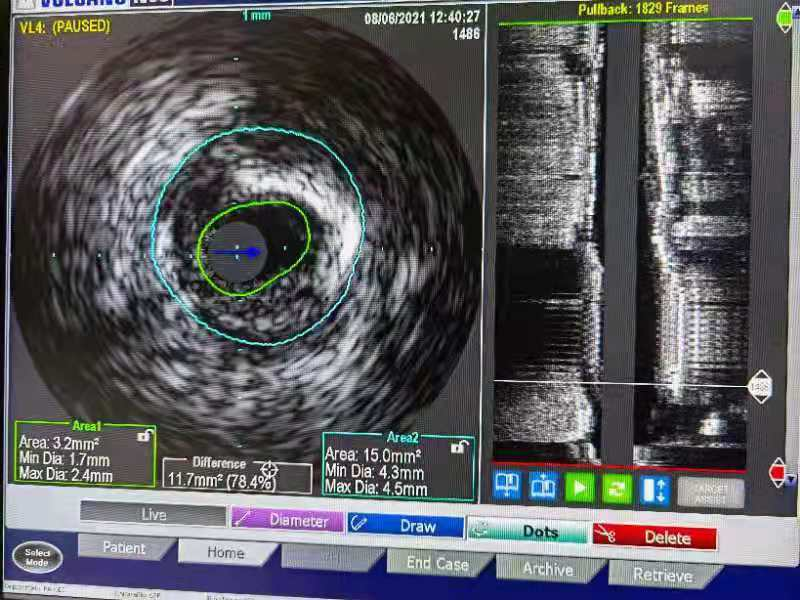 南昌市第三医院成功开展首例经IVUS指引下的冠脉病变的介入精准治疗