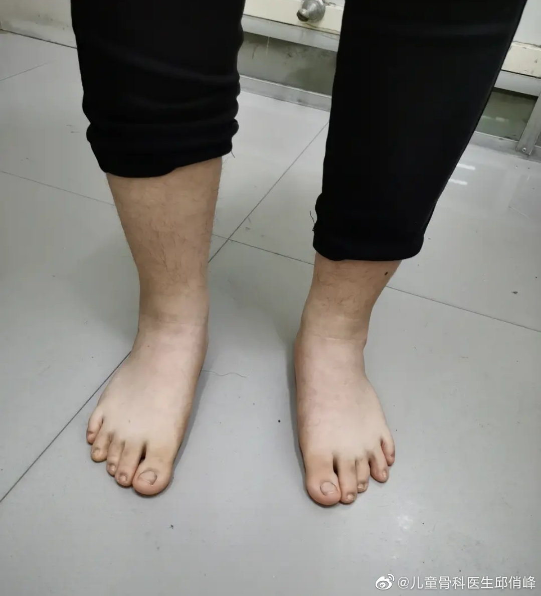 三年前的足外翻女孩,当时她15岁,走路疼,上学要人送上楼