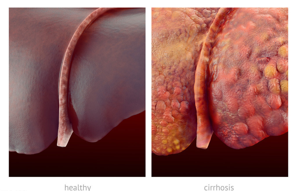 警惕!容易被很多人忽视的脂肪肝同样会引起肝炎,肝硬化