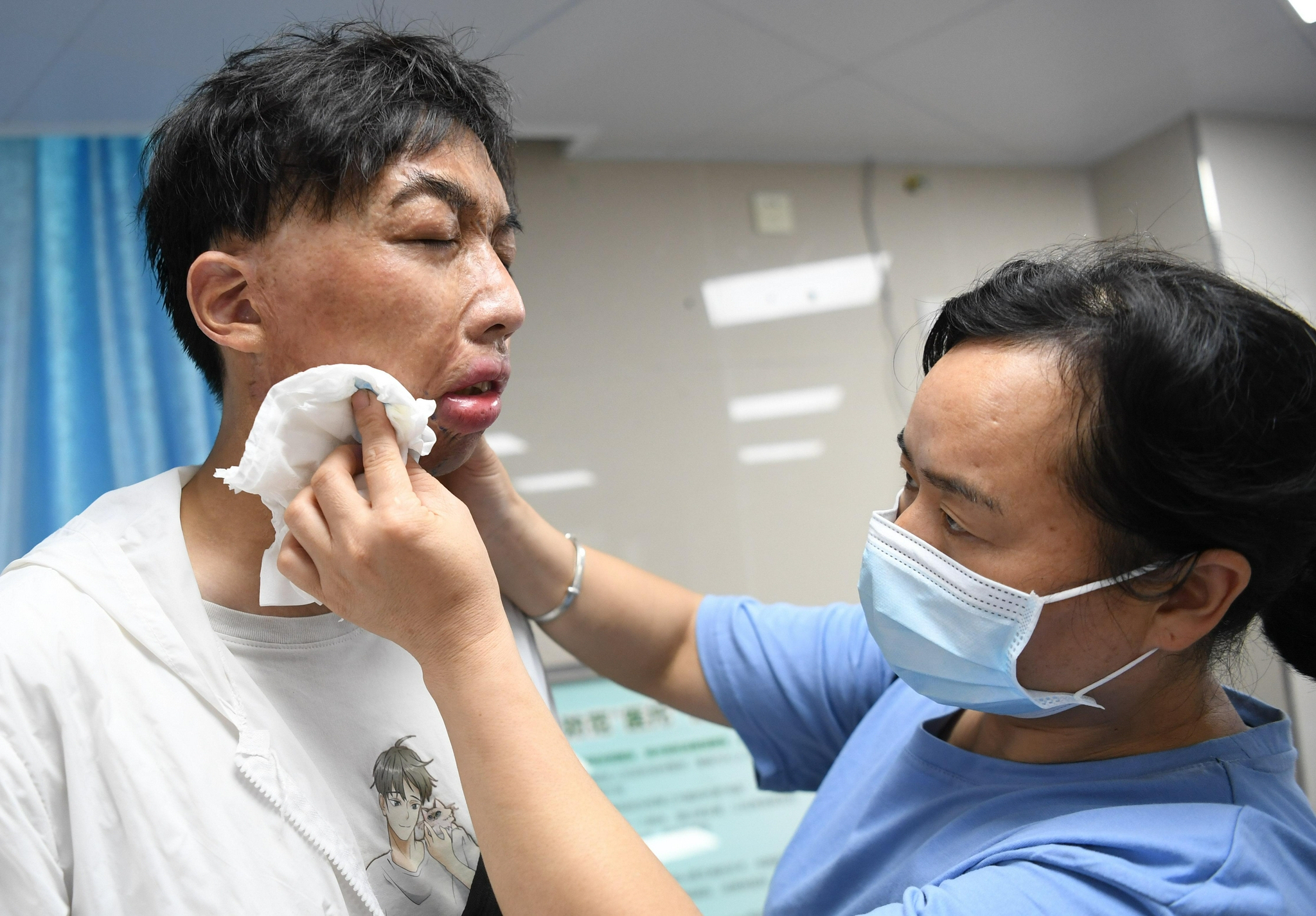 7月12日,"面具男孩"周涛的妈妈为他擦去脸上标记手术位置的记号笔痕迹