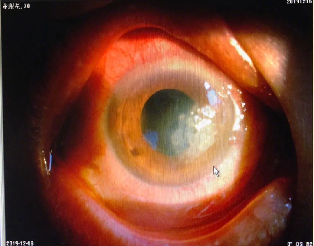 他用了一周眼药水,眼睛越来越难受,左眼完全看不清了……   家人