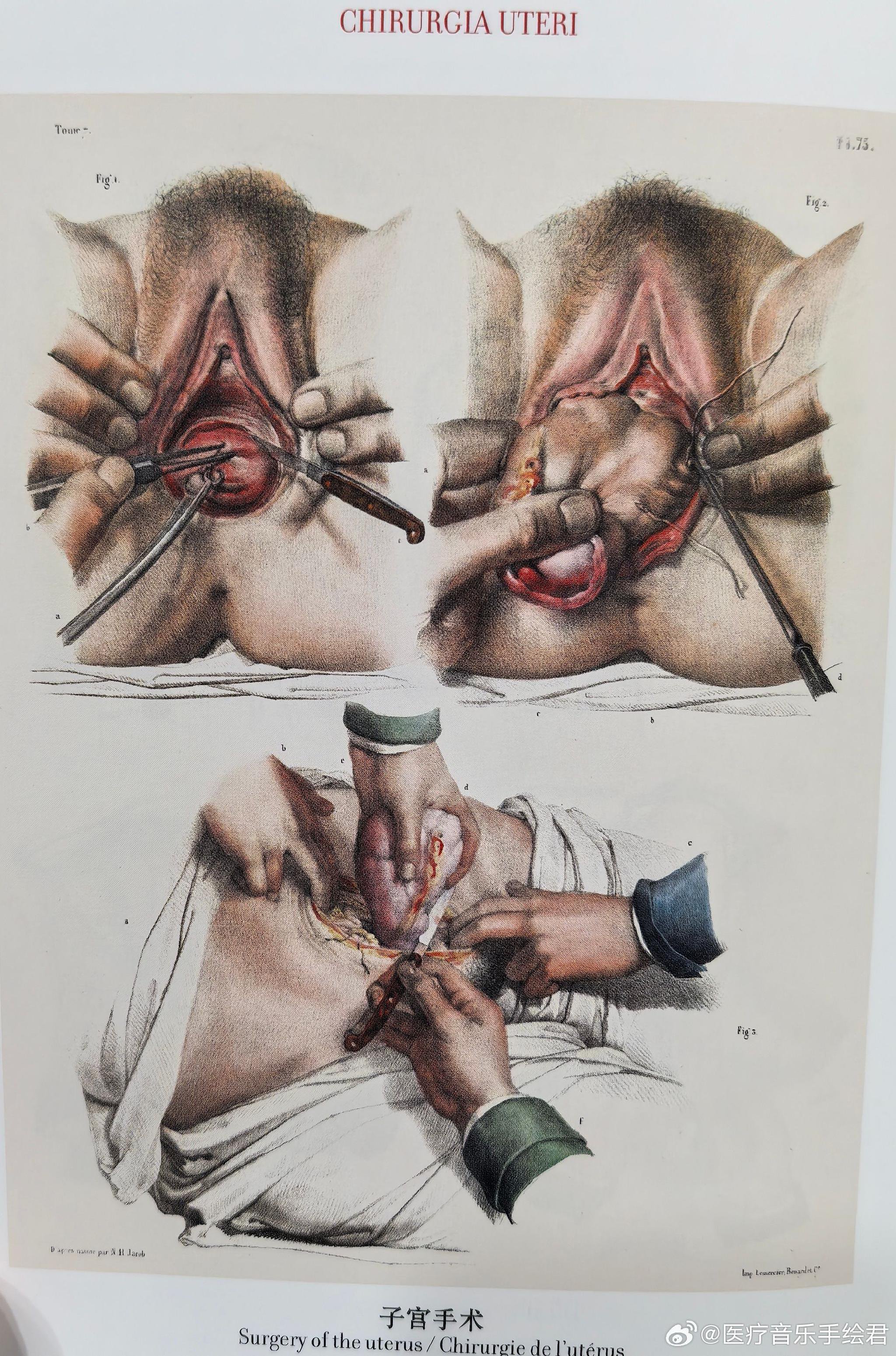 医学绘图:子宫手术,图源:《人体解剖学完全图谱》法国解剖学家j