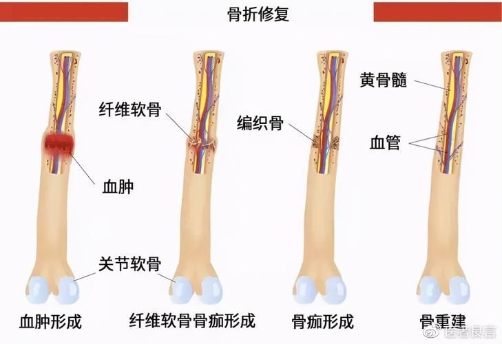 判断是否骨折痊愈,需要判断是否存在反常活动,压痛以及轴向叩击痛
