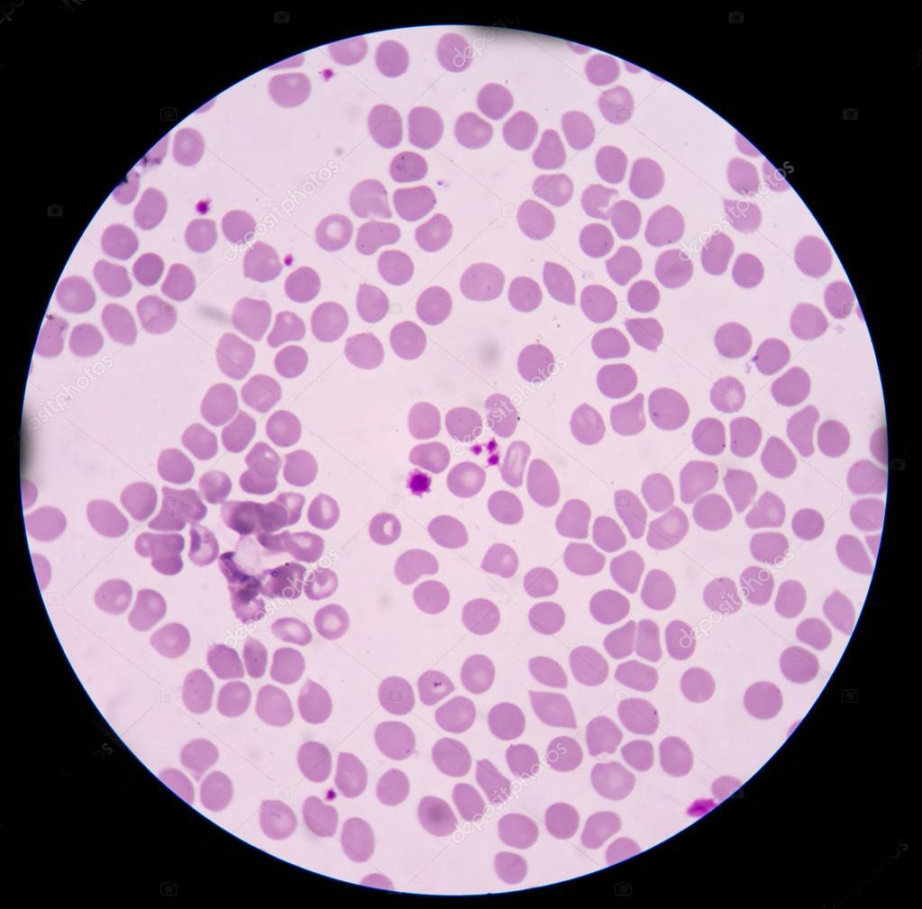 这种血细胞与癌症发生相关为何晚期肿瘤病人会异常升高