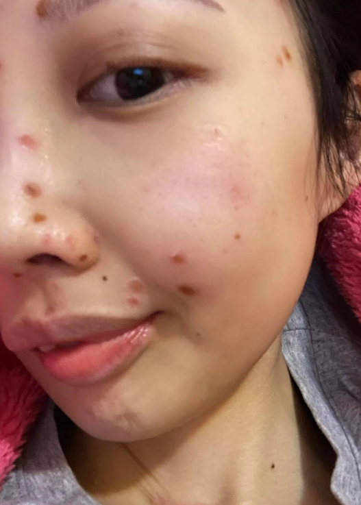 无力回天31岁香港女星抗癌九年病情恶化呼吸困难瘦成皮包骨