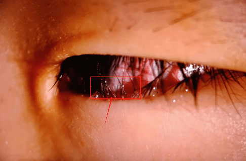 东莞5岁女童眼睫毛倒着长导致眼角膜溃疡