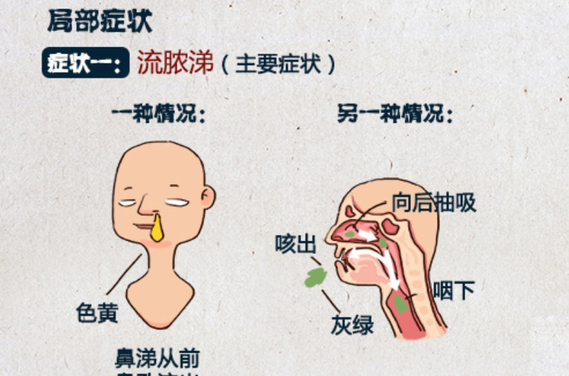 儿童鼻窦炎知识您知多少？需要抗生素吗？用多久？