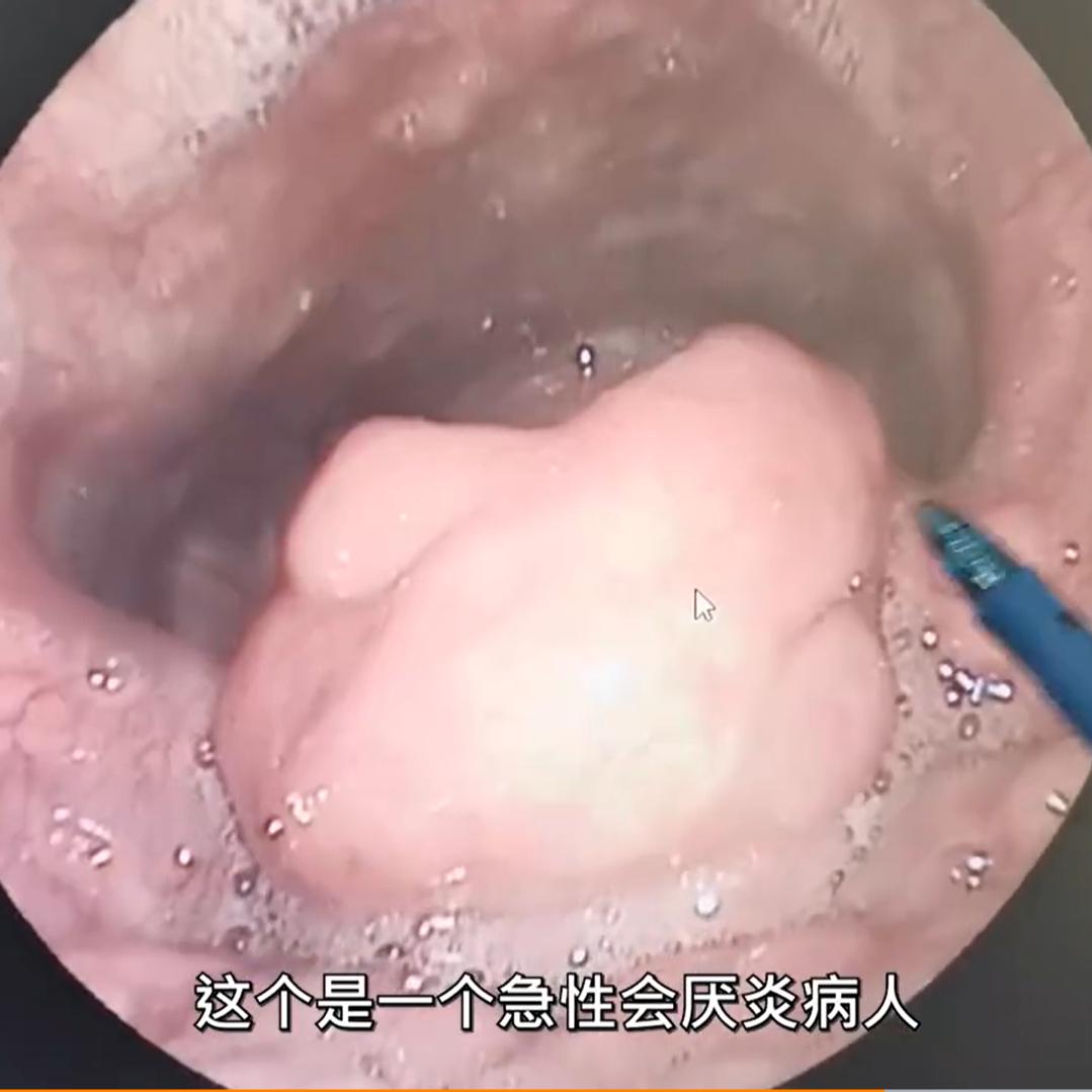 大学生嗓子疼就医查出急危重症：病情发展快速或致窒息，死亡率较高休闲区蓝鸢梦想 - Www.slyday.coM