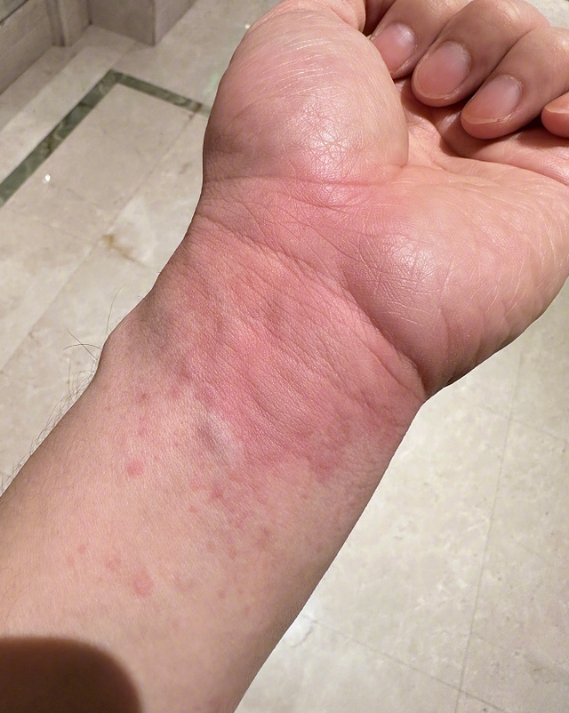 肠胃难受为什么起鸡皮疙瘩(肠胃难受为什么起鸡皮疙瘩呢) 肠胃难受为什么起鸡皮疙瘩(肠胃难受为什么起鸡皮疙瘩呢)