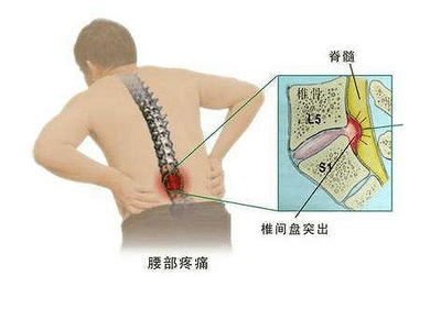 【解答】腰痛,分不清是腰肌劳损还是腰椎间盘突出?看这篇立刻搞定!