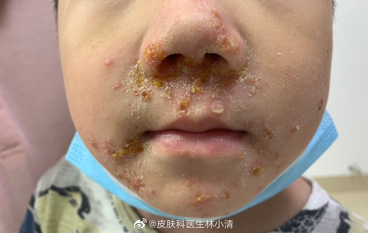 脓疱病,又叫脓疱疮或黄水疮,是细菌感染,有很强的传染性