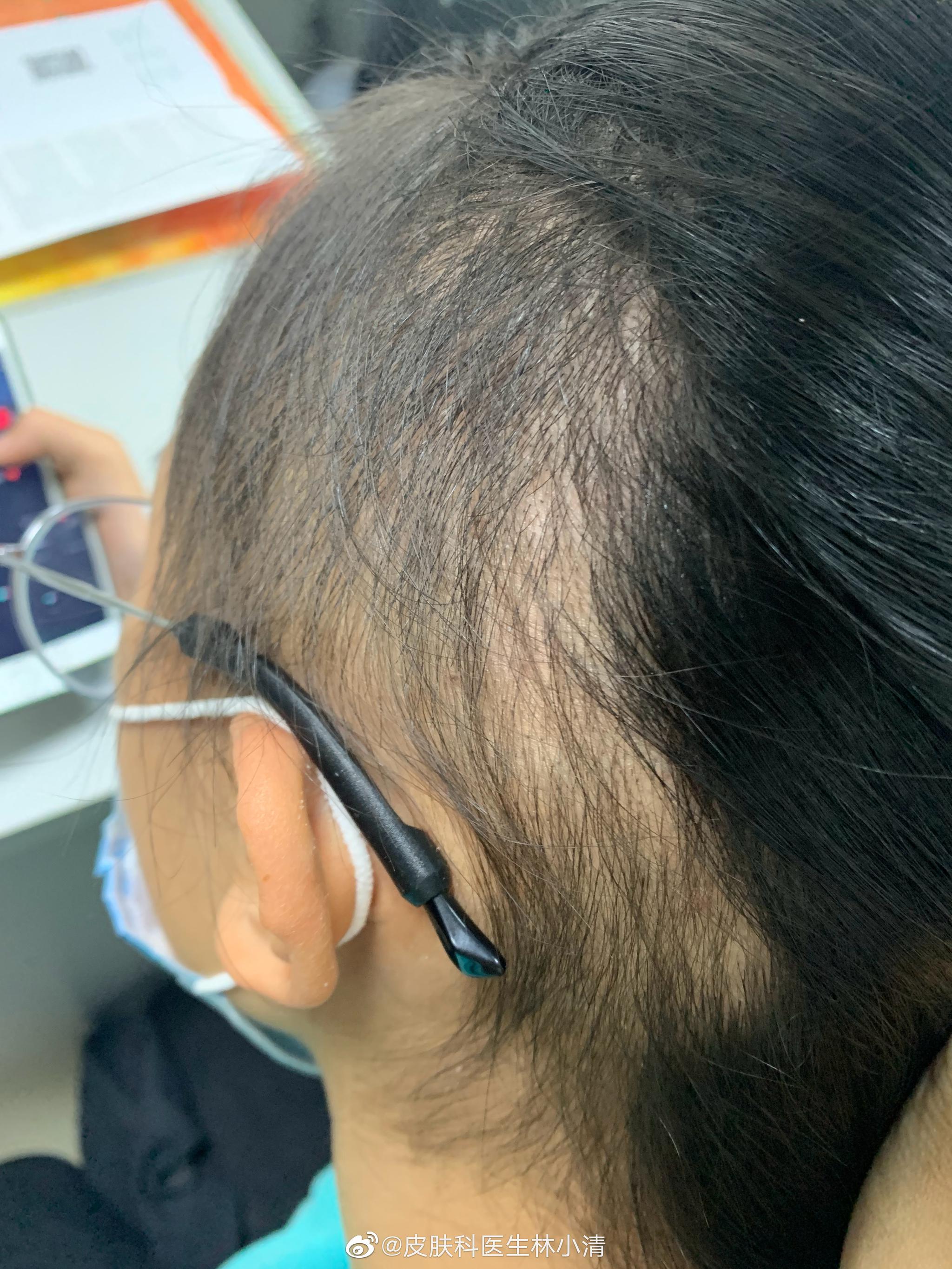这位患者是典型的拔毛癖 是一个11岁的女孩子 这位患者是典型的拔毛癖 是一个11岁的女孩子