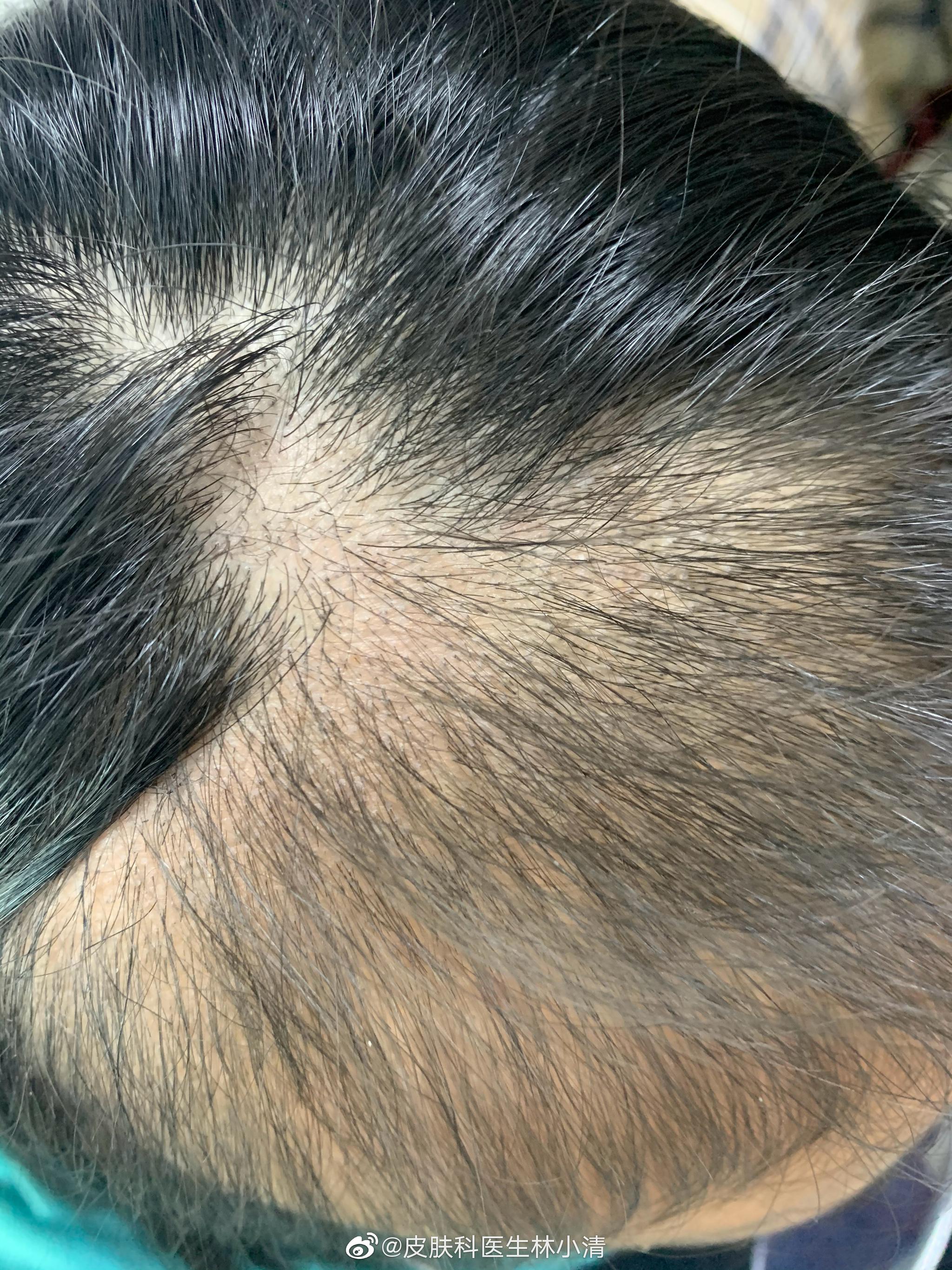这位患者是典型的拔毛癖 是一个11岁的女孩子 这位患者是典型的拔毛癖 是一个11岁的女孩子