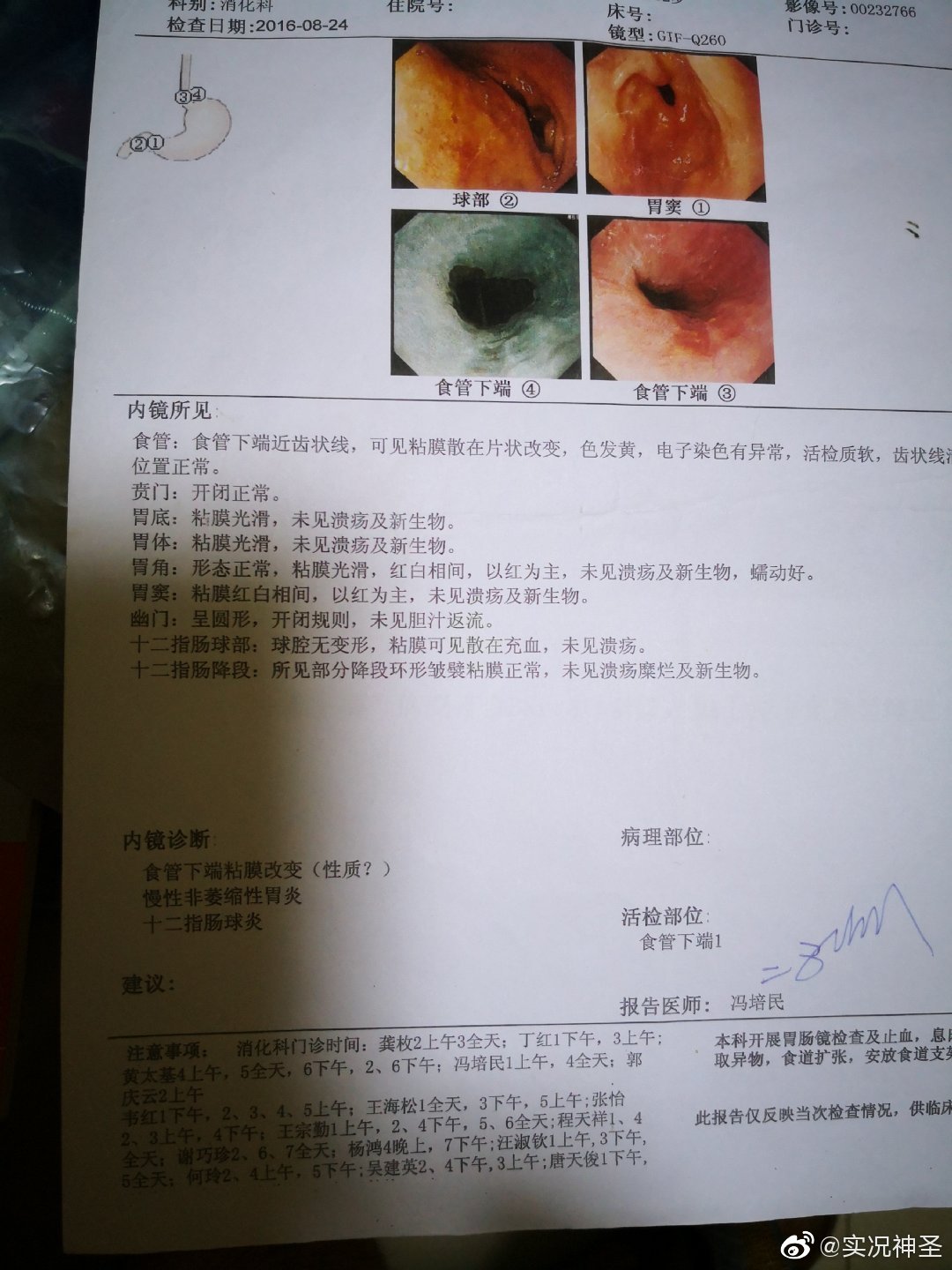 我还胰腺炎40度发烧做过活检,查出巴瑞特食管,我都没全麻,看着做的,我