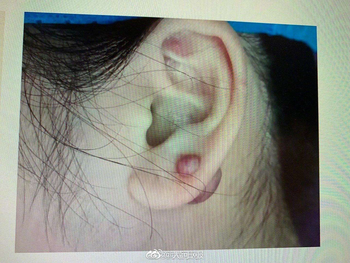 女子打耳洞竟打出肉疙瘩 专家提醒小心染上传染病|传染病|打耳洞|疙瘩