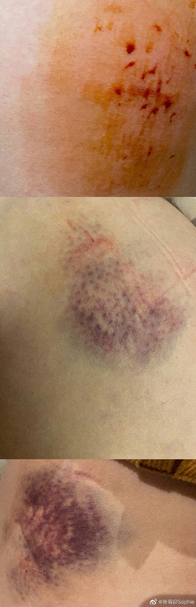 还晒出了一组自己的伤情照,虽然看不清楚受伤的部位,要么一大片的淤青