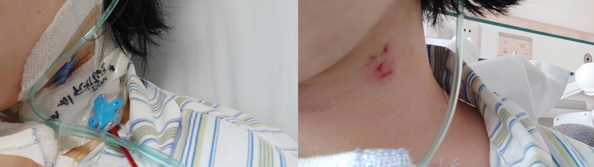 原以为要换个心脏零件,开胸之后我收到了意外的礼物|手术|心脏彩超