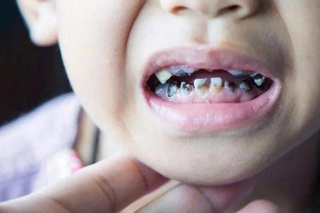 "元凶"可不是糖果,而是宝妈"顾前不顾后"|宝宝|黑牙|牙齿_新浪新闻