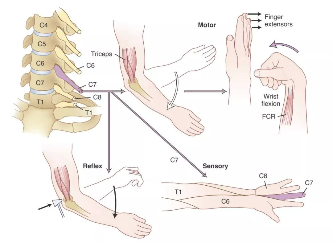 感觉障碍无明确平面;四肢深反射活跃或亢进;锥体束征(hoffmann征)阳性
