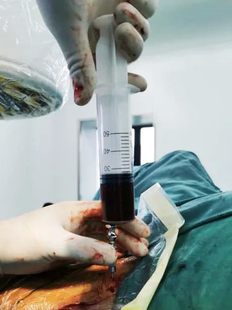 微创骨髓血移植南昌市第九医院骨科新技术治疗青壮年股骨颈骨折