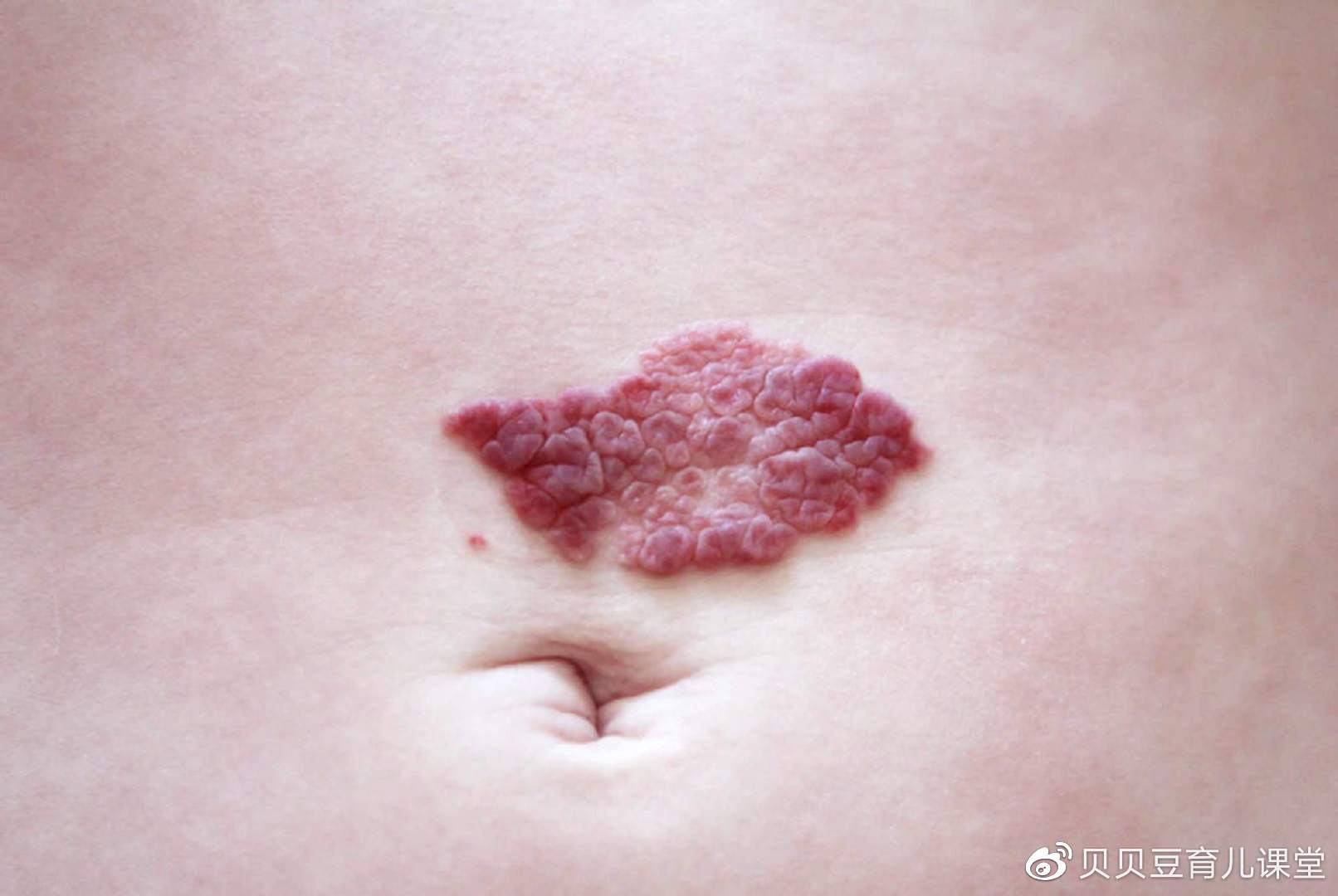 新生儿额头现心形胎记天使之吻还是恶魔印记要能分得清