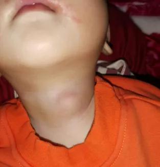 7个月大的轩轩,妈妈给他洗澡时,无意间发现脖子里鼓了一个包,当时孩子