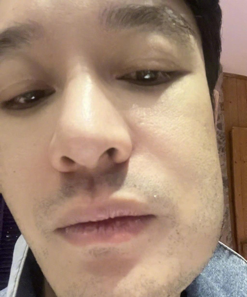 脸肿表情包+1!黄晓明晒拔完智齿后自拍,好像被蜜蜂蛰的狗狗休闲区蓝鸢梦想 - Www.slyday.coM 脸肿表情包+1!黄晓明晒拔完智齿后自拍,好像被蜜蜂蛰的狗狗休闲区蓝鸢梦想 - Www.slyday.coM