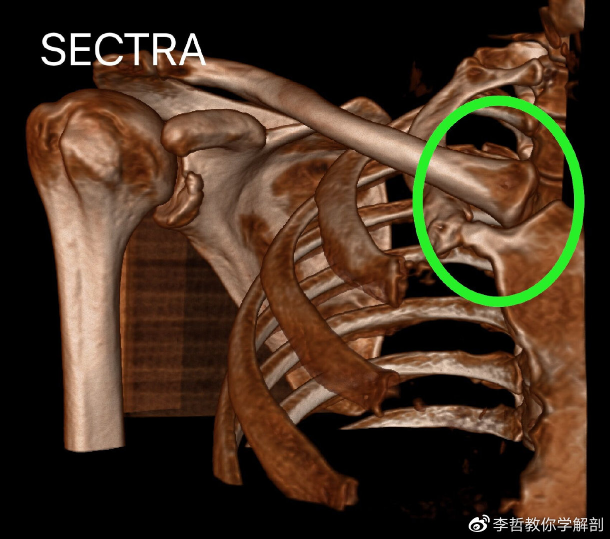 肩鎖關節連接因為兩個肩胛骨綠色:肩鎖關節在背側沒有連接,是一個不