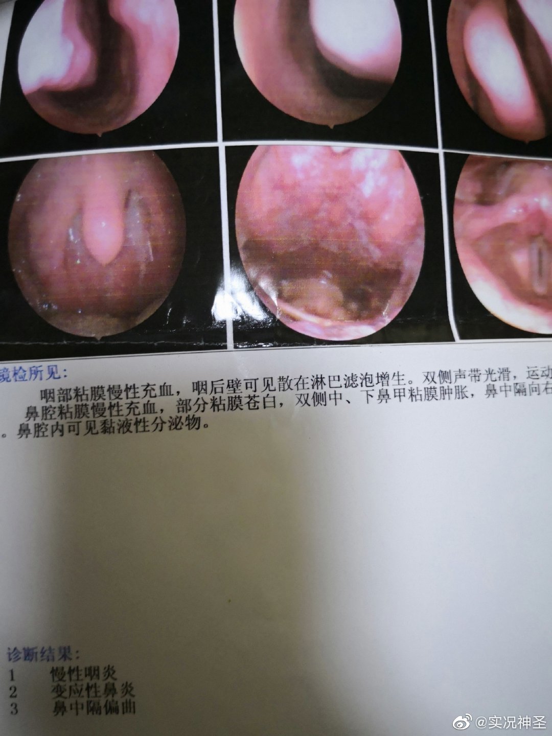 我呼吸暂停综合征肠鸣音亢进脂肪肝