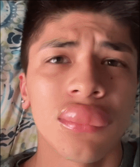 外网小哥因为被黄蜂赐予了"烈焰红唇"引来千万人围观